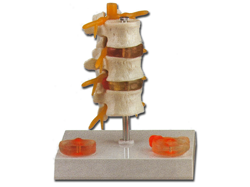 Hernia Pathology  Model
