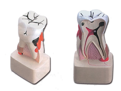 Dental Pathology 4X life Size Model