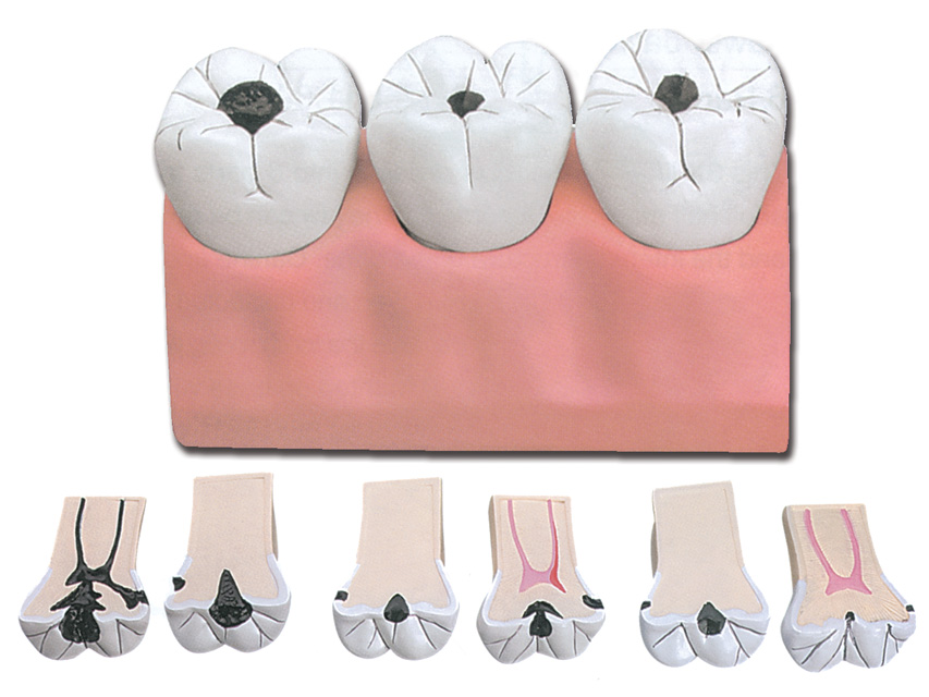 Dental Caries Model In 7 Parts