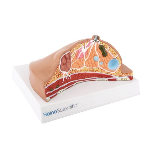 Diseased Breast Model