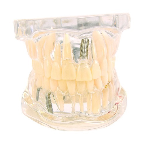 Transparent Jaw Model With Various Diseases Adult