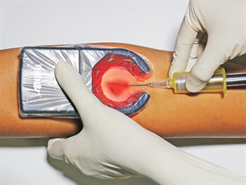 Hand Held Vein Finder