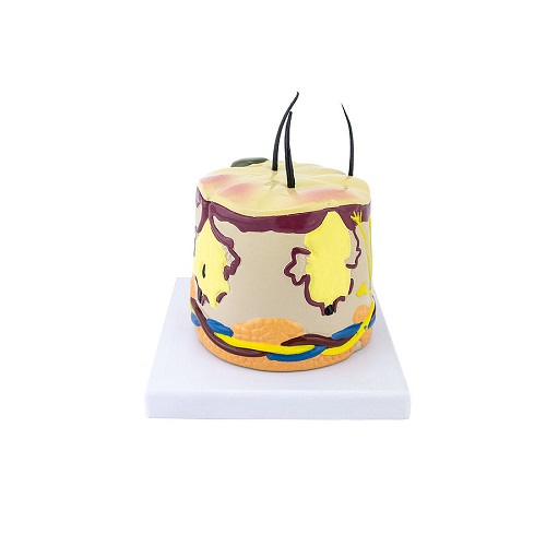 Acne  Cylindrical Sectional Model