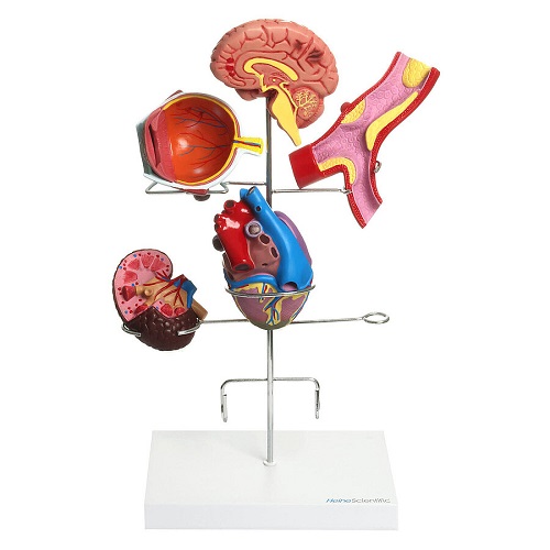 Hypertension Set Model