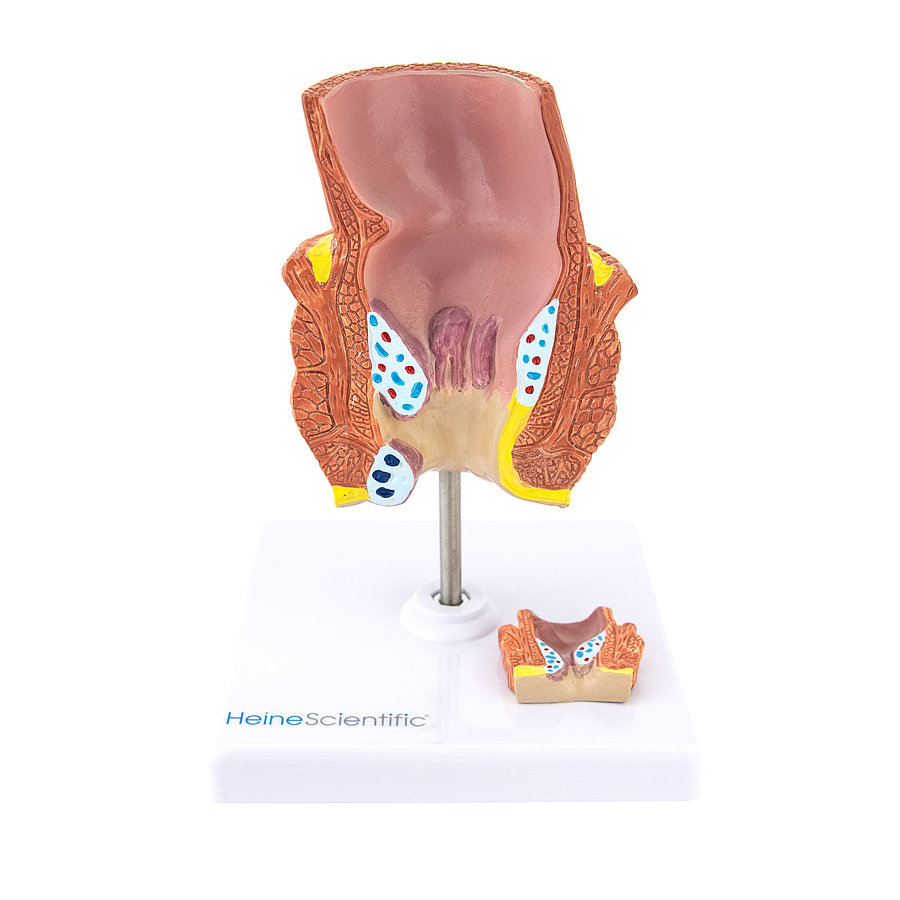 Model Of Rectum With Haemorrhoids