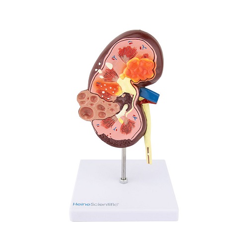 Kidney Disease Model
